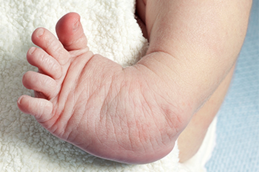 Checking Newborn Feet and What Doctors Look For