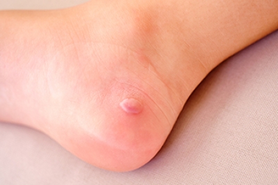 Managing Blisters on the Feet
